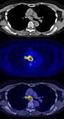 Non-Hodgkin lymphoma, CT and PET scans