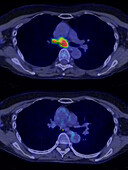 Non-Hodgkin lymphoma, CT-PET scan