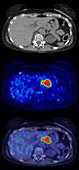 Non-Hodgkin lymphoma, CT and PET scans