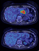 Non-Hodgkin lymphoma, CT-PET scan