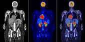 Diffuse large B-cell lymphoma, CT and PET scans