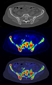 Pelvic bone metastases from breast cancer, CT and PET scans
