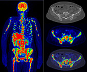 Metastatic breast cancer, PET and CT scans
