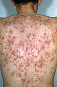 Severe acne vulgaris on a man's back