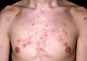 Nodular acne on a man's chest