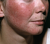 Cutaneous sarcoidosis on a woman's face