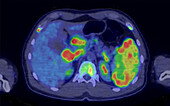 Hodgkin lymphoma, CT-PET scan