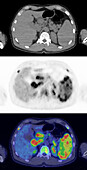 Hodgkin lymphoma, CT and PET scans