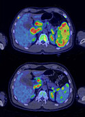 Hodgkin lymphoma recurrence, CT-PET scans
