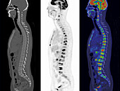 Hodgkin lymphoma, CT and PET scans