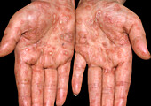 Secondary syphilis lesions on a woman's hands
