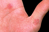 Secondary syphilis lesions on a man's hand