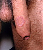 Secondary syphilis lesion on a man's penis