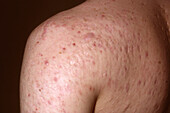 Acne vulgaris on a man's shoulder