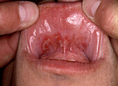 Erythema multiforme in a man's mouth