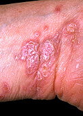 Lichen planus on a woman's wrist