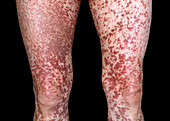 Skin lesions due to mastocytosis on a man's legs