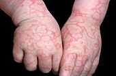Fifth disease on a girl's hands