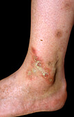 Diabetic skin lesions on a woman's ankle