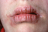 Angular cheilitis in a woman's mouth