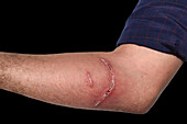 Jellyfish stings on a man's forearm