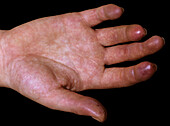 Systemic scleroderma on a man's hand