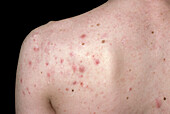 Acne vulgaris
