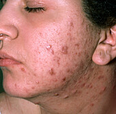 Acne vulgaris