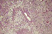 Glioblastoma, light micrograph