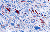 Glioblastoma, light micrograph