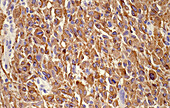 Glioblastoma, light micrograph