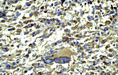 Glioblastoma, light micrograph