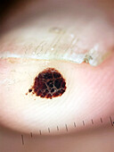 Small blood blister, dermoscopy