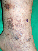 Acral melanosis
