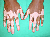 Vitiligo in Addison's disease