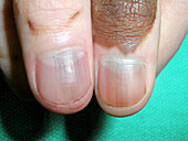 Hyper pigmented nails in Addison's disease