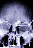 Bony growth in the frontal sinus, X-ray