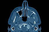 Infected maxillary sinus, CT scan