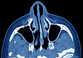 Maxillary sinuses, CT scan