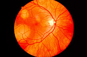 Choroidal metastatic lesions in left eye, fundoscopy scan