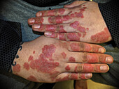 Plaque psoriasis not responding to treatment