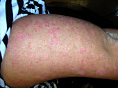 Plaque psoriasis not responding to treatment