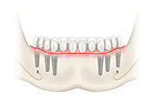 Lower jaw prosthesis and implants, illustration