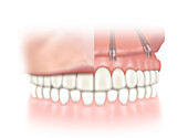 Upper jaw implants, illustration
