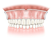 Denture on maxillary arch with mandible, illustration