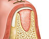 Resorbable collagen matrix with suture over a jaw, illustration