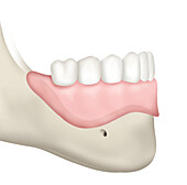 Prosthesis on resorbed mandible, illustration