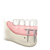 Bar-supported prosthesis on resorbed mandible, illustration