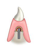 Lower jaw tooth with bar-supported prosthesis, illustration