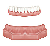 Lower jaw arch prothesis and edentulous mould, illustration